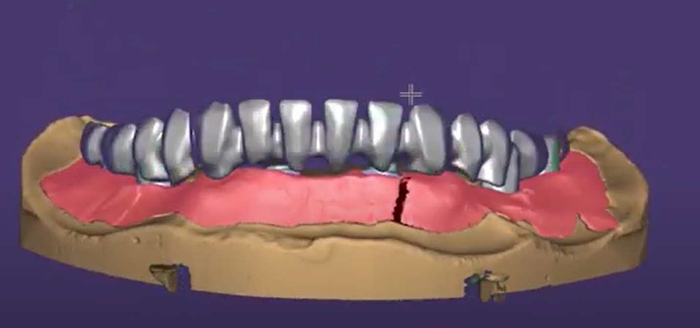 Implant restoration