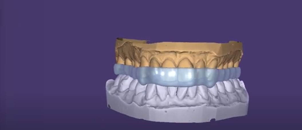3D printed night guard
