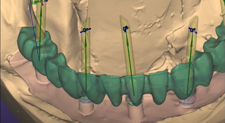 Angulated implants