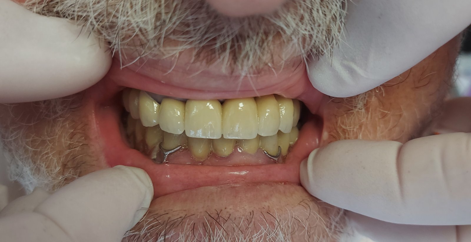 10-unit Crown Bridge